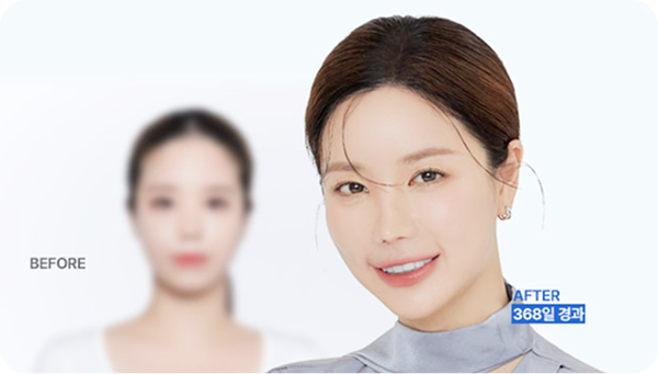 정수리 탈모로 10년 고민, 드디어 해결!