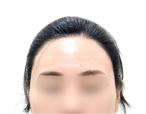 여성 절개 모발이식 after