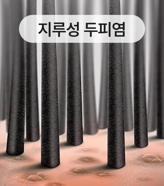 지루성 두피염